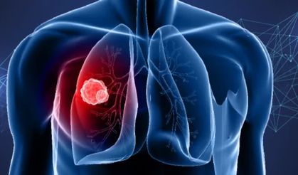 Akciğer kanseri sigara içmeyenlerde de artmaya başladı